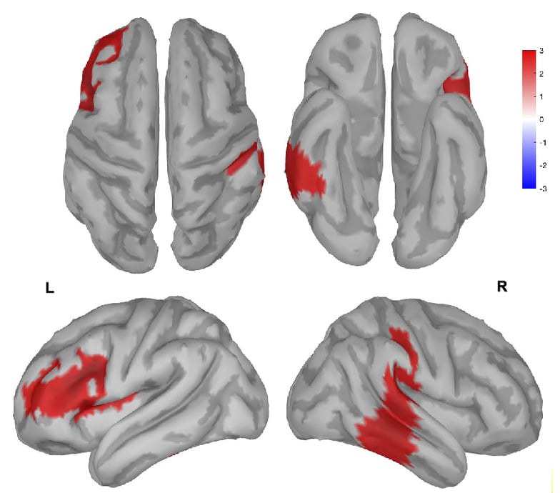 Source analysis of the delta EEG activity associated with the FF condition. Significant differences (P < 0.01, cluster-based correction) in T1/T0 delta ratios between FF and NF. Specifically, difference peaks were found in the left IFG (−36, 16, 28) and in the right middle temporal lobe (70, −30, −2).