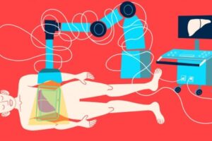 illustration of sound wave procedure on liver cancer
