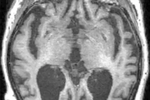 This MRI scan shows a brain with Alzheimer's disease