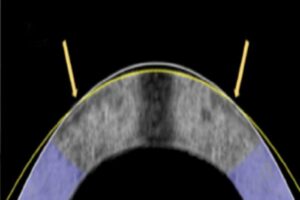 The electromechanical reshaping technique successfully flattened this rabbit cornea, shown in cross section, from its original shape (white line) to its corrected shape (yellow line).