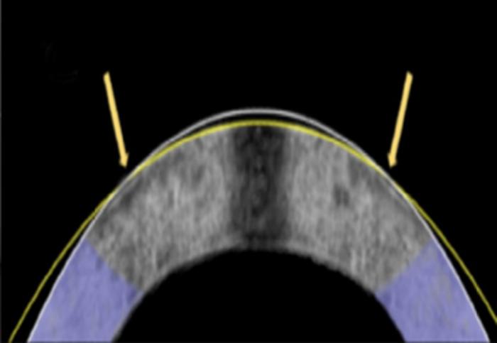 The electromechanical reshaping technique successfully flattened this rabbit cornea, shown in cross section, from its original shape (white line) to its corrected shape (yellow line).