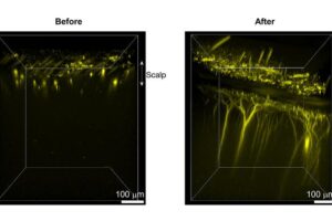 Left: 3D reconstruction of two-photon excited YFP-H fluorescence in the live mouse cortex before treatment with ampyrone. Only YFP signals in the scalp can be seen due to the scattering of the scalp. Right: 3D reconstruction of two-photon excited YFP-H fluorescence of the same region after achieving scalp transparency with ampyrone. | The Hong Lab