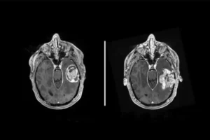 glioblastoma brain scan