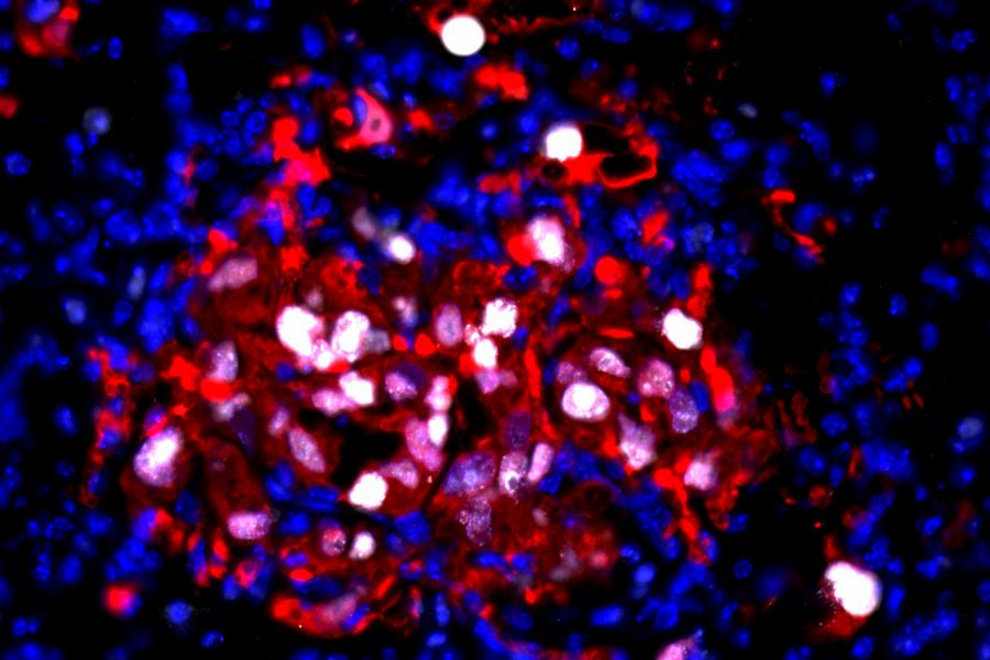 In this image, tdTomato cancer cells (red) are seen awakened by chemotherapy-induced inflammation, while Ki67 (white) marks proliferating cells.