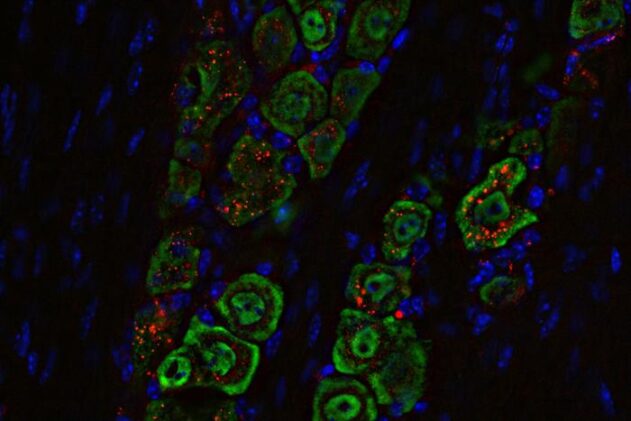 Researchers at WashU Medicine have developed a noninvasive medicine delivered through the nose that successfully eliminated deadly brain tumors in mice. The medicine is based on a spherical nucleic acid, a nanomaterial (labeled red) that travels along a nerve (green) from the nose to the brain, where it triggers an immune response to eliminate the tumor.