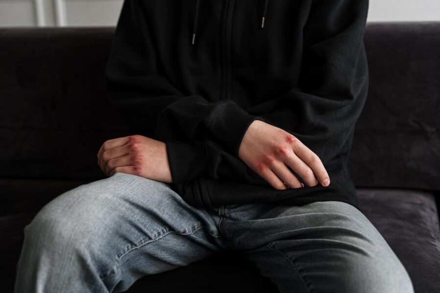 a man sitting, with sore, red knuckles as if he has been hitting something