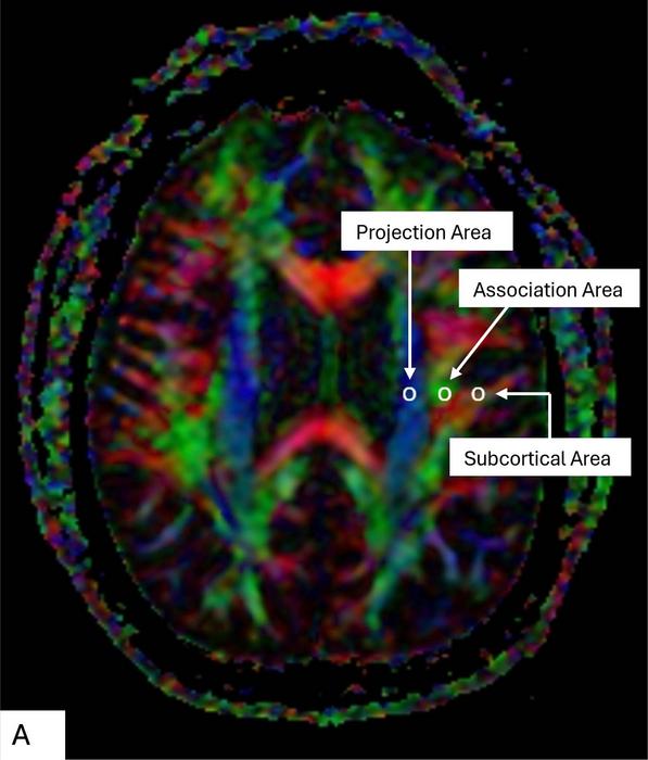 The brain’s waste-clearing system shows a marked decline in function after repeated head impacts, according to a new study of cognitively impaired professional