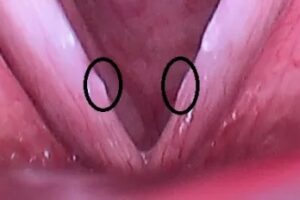 Figure 3. Participant vocal fold lesions following scream (courtesy of authors).