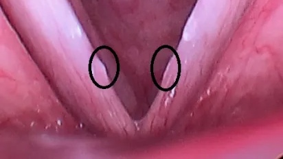 The Biomechanics of a Scream: Why an Angry Yell Can Hurt Your Voice