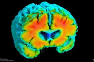 Amyloid PET imaging