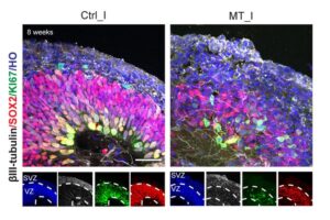 The scientists studied brain organoids derived from patients suffering from a newly discovered genetic disease. These organoids had a more disorganized structure and fewer properly patterned developing nerve cells than healthy controls, suggesting impaired brain development.