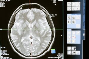 Brain CAT scan