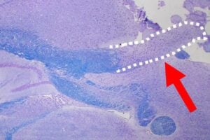 The image shows a section of the brain of a mouse treated with dasatinib and quercetin. The bluish area is the corpus collosum. The dotted outline shows the part of the corpus collosum that is affected by the dasatinib and quercetin. CREDIT: Crocker Lab/UConn School of Medicine.