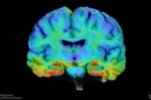 The colors show how much tau was detected in different parts of the brain. Blue marks areas with lower levels, while red marks areas with higher levels.