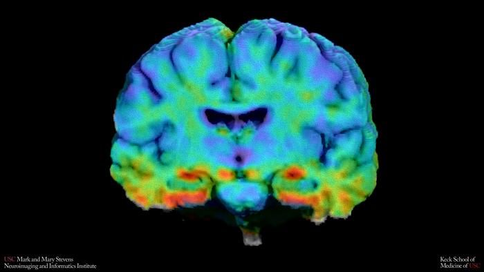 Alzheimer’s Brain Scans Trained on White Patients May Be Missing Warning Signs in Others