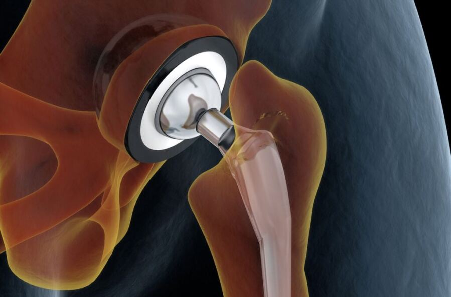 Turmeric and Ginger Coatings on Titanium Implants Kill Bacteria and Boost Bone Growth