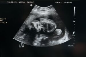 ultrasound of fetus