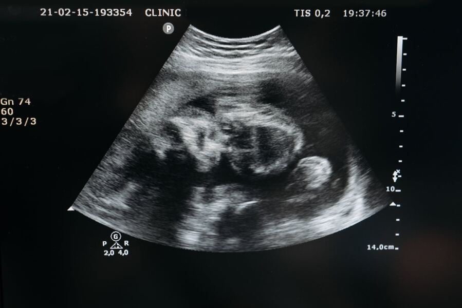 Childhood Seizures Begin in the Womb, New Research Reveals