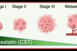 As melanoma progresses, natural catestatin levels decrease, suggesting that catestatin may be able to slow melanoma growth.