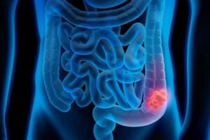 Colorectal cancer is on the rise among young adults. An international research effort led by UC San Diego bioengineers has uncovered that DNA mutations arising during early childhood from a bacterial toxin called colibactin are a potential cause.