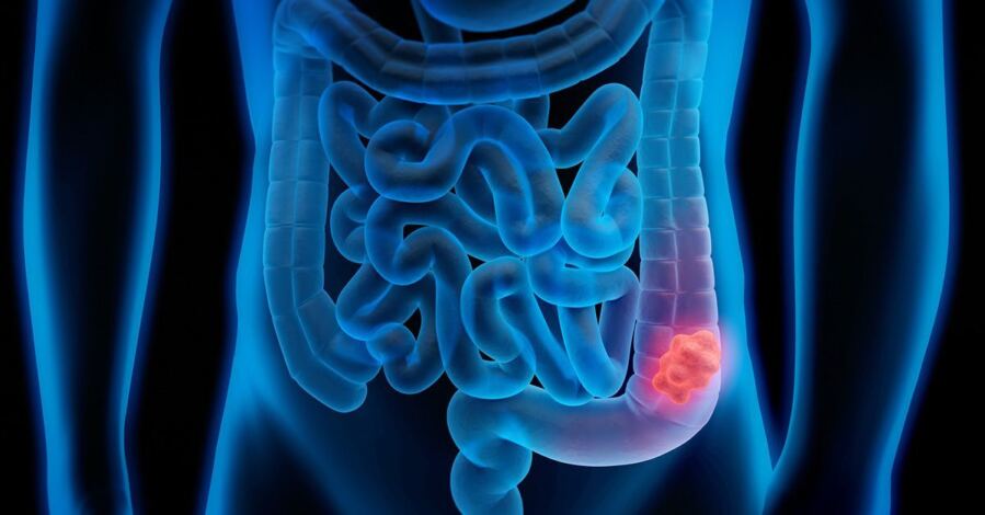 Gut Bacteria May Be Priming Young Adults for Colon Cancer Decades Before Diagnosis