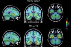 PET brain scans from the same individual with early signs of Alzheimer’s disease comparing two tau radiotracers: flortaucipir, shown at top, and the investigational tracer MK6240, shown at bottom. Areas of pathological tau accumulation appear in red. The MK6240 scan shows more extensive tau buildup, suggesting that this tracer may detect Alzheimer’s-related brain changes that are less visible with the standard tracer.