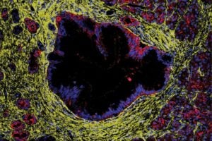 Immunofluorescence image of human donor pancreas with a precursor lesion lined by epithelial cells surrounded by fibroblasts.