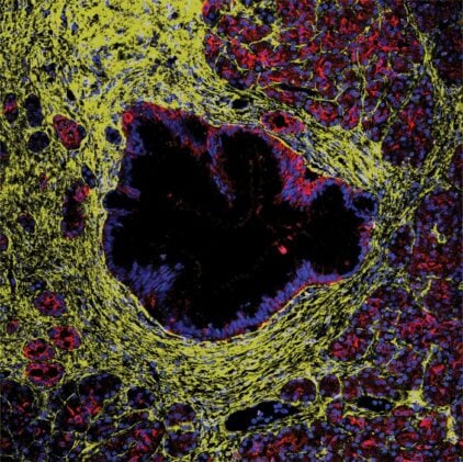 Immunofluorescence image of human donor pancreas with a precursor lesion lined by epithelial cells surrounded by fibroblasts.