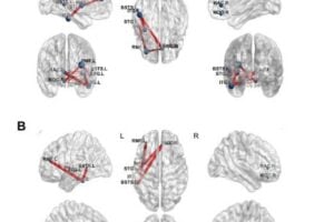 Researchers analyzed implanted brain-electrode recordings before and after radiofrequency thermocoagulation (RF-TC) to show how targeted heat treatment reshapes seizure-related brain networks.