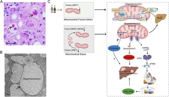 Alcohol-induced mitochondrial changes in liver disease. (A) Human Liver: Staining from a patient with alcohol-associated hepatitis. (B) Mouse Liver: Electron microscopy after alcohol feeding. Arrows show abnormally enlarged mitochondria (megamitochondria). Scale bars: 100 μm (A), 500 nm (B). (C) Mechanism: Alcohol reduces the protein DRP1, stopping normal mitochondrial splitting (fission) and trapping mitochondria in an inactive state (stasis, gray module). Disease Progression: While new megamitochondria temporarily protect the liver by boosting metabolism, chronic alcohol exposure destroys this defense. The damaged mitochondria then leak signals that trigger cell death, severe inflammation (via cGAS–STING), and abnormal cell growth, ultimately driving liver injury and tumors.