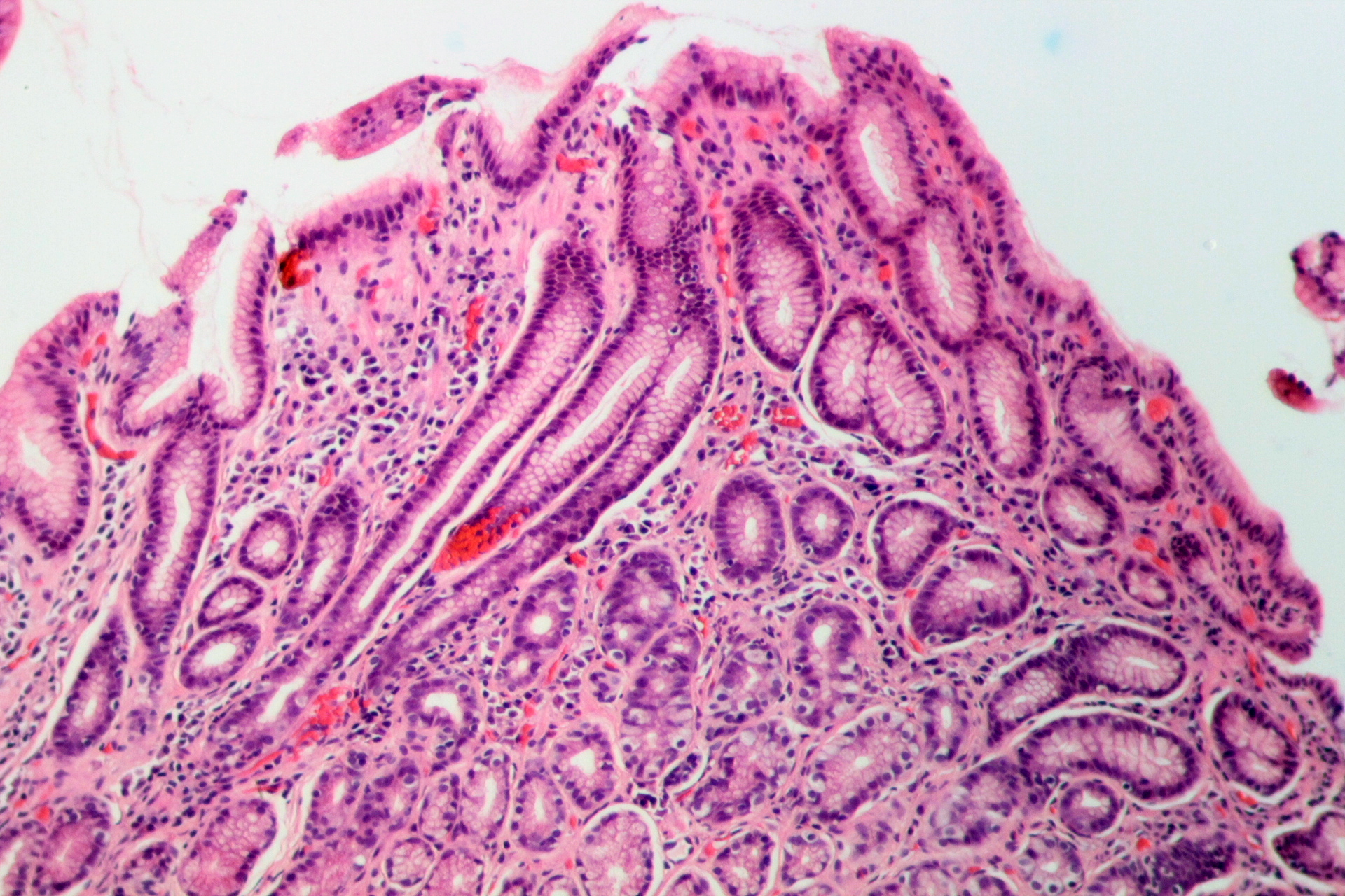 Histopathology of gastritis due to Helicobacter pylori (H&E stain)