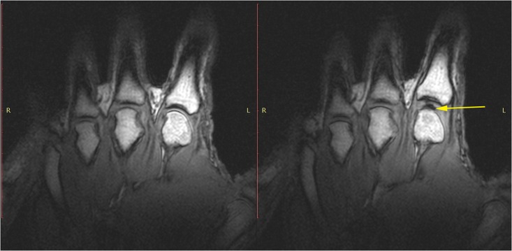 Two MRI scans of the same finger joint side by side.