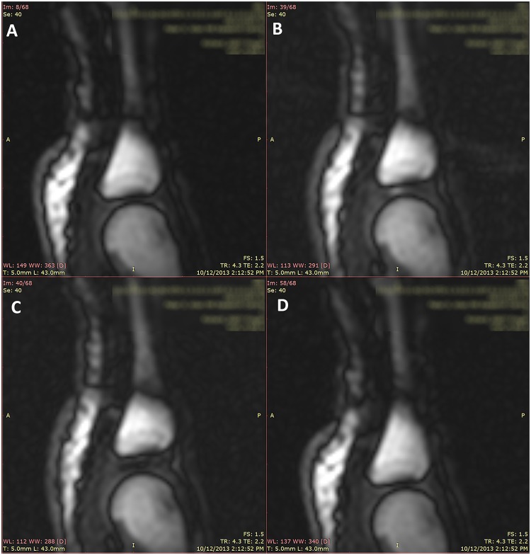 Four MRI frames of the same finger joint in a row. The joint at rest, then being pulled just before cracking, then just after cracking with a dark gap inside the joint, and finally after the pulling stops.